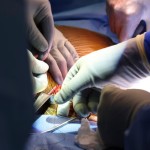 First recipient of gene-edited pig kidney transplant dies.